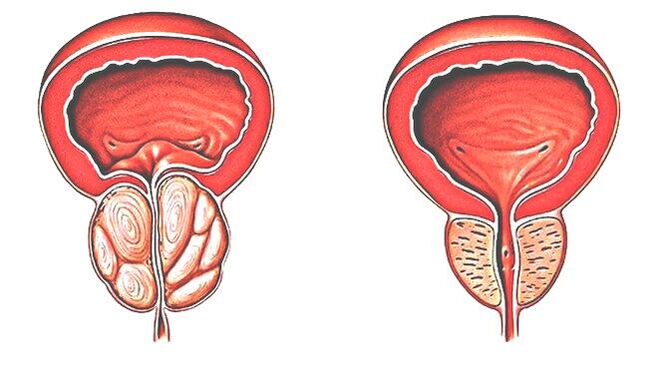 Prostatitis und normale Prostata. 