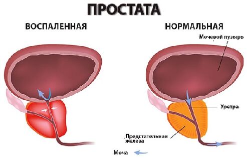 Prostata