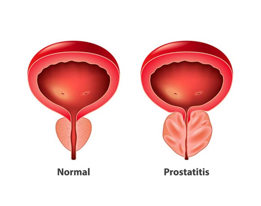 Normale und entzündliche Prostata
