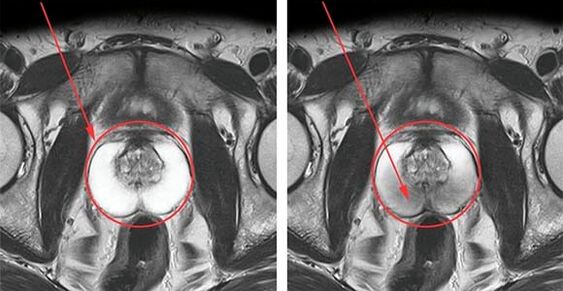Normale Prostata (links) und Prostataentzündung mit Prostatitis (rechts)